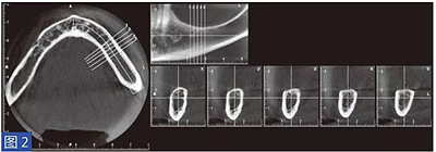 柵欄技術(shù)用于局部三維骨增量 &mdash;技術(shù)概述與病例匯報 （1）
