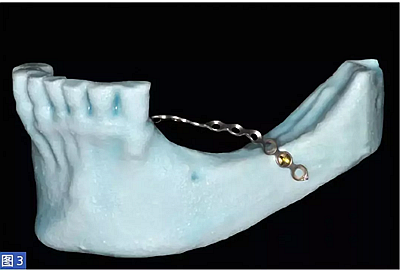 柵欄技術(shù)用于局部三維骨增量 &mdash;技術(shù)概述與病例匯報 （1）