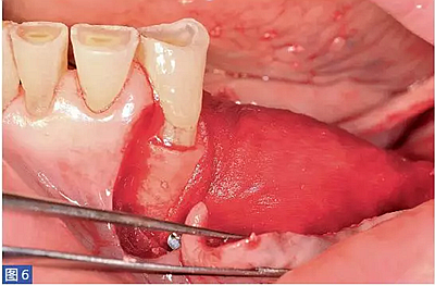 柵欄技術(shù)用于局部三維骨增量 &mdash;技術(shù)概述與病例匯報 （1）