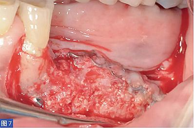 柵欄技術(shù)用于局部三維骨增量 &mdash;技術(shù)概述與病例匯報 （1）