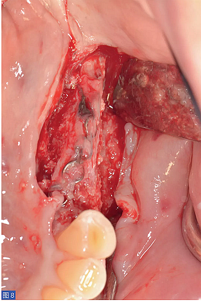 柵欄技術(shù)用于局部三維骨增量 &mdash;技術(shù)概述與病例匯報 （1）