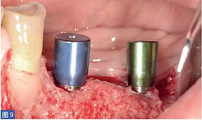 柵欄技術(shù)用于局部三維骨增量 &mdash;技術(shù)概述與病例匯報 （1）