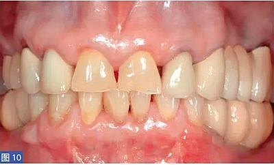 柵欄技術(shù)用于局部三維骨增量 &mdash;技術(shù)概述與病例匯報 （1）