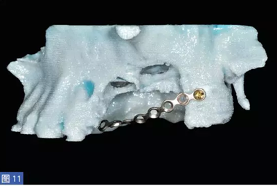 柵欄技術(shù)用于局部三維骨增量 &mdash;技術(shù)概述與病例匯報 （1）