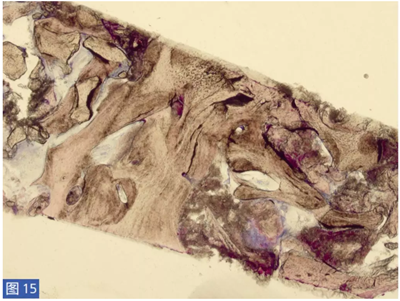  柵欄技術(shù)用于局部三維骨增量 &mdash;技術(shù)概述與病例匯報 （2）