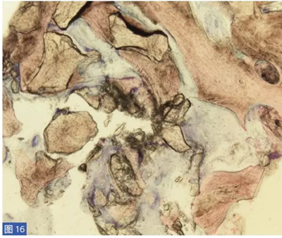  柵欄技術(shù)用于局部三維骨增量 &mdash;技術(shù)概述與病例匯報 （2）