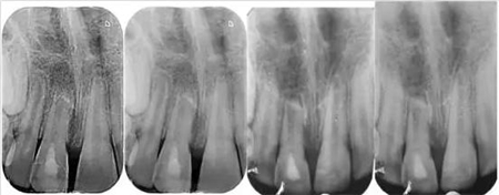 文獻(xiàn)綜述|年輕恒牙挫入脫位的多學(xué)科治療 文獻(xiàn)綜述|年輕恒牙挫入脫位的多學(xué)科治療