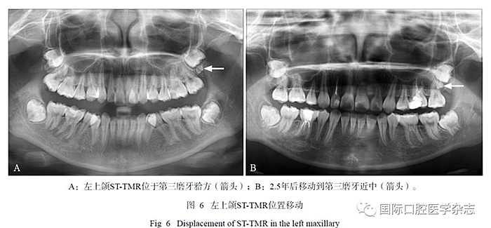 46例患者第三磨牙區(qū)多生牙的影像學(xué)分析 46例患者第三磨牙區(qū)多生牙的影像學(xué)分析