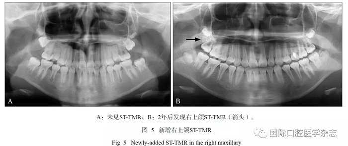 46例患者第三磨牙區(qū)多生牙的影像學(xué)分析 46例患者第三磨牙區(qū)多生牙的影像學(xué)分析