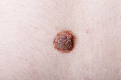 嘴巴里黑黑的好像長(zhǎng)了「痣」？你要當(dāng)心了