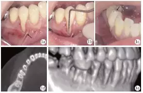 側向轉位瓣結合上皮下結締組織移植治療重度MillerⅢ°牙齦退縮1例 側向轉位瓣結合上皮下結締組織移植治療重度MillerⅢ°牙齦退縮1例