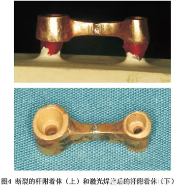 【經(jīng)驗(yàn)分享】無牙頜種植修復(fù)固位的并發(fā)癥與處理——宋應(yīng)亮教授 【經(jīng)驗(yàn)分享】無牙頜種植修復(fù)固位的并發(fā)癥與處理——宋應(yīng)亮教授