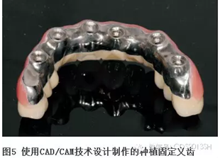 【經(jīng)驗(yàn)分享】無牙頜種植修復(fù)固位的并發(fā)癥與處理——宋應(yīng)亮教授 【經(jīng)驗(yàn)分享】無牙頜種植修復(fù)固位的并發(fā)癥與處理——宋應(yīng)亮教授