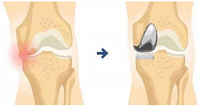 關(guān)于鈷合金致癌，BEGO有話要說！
