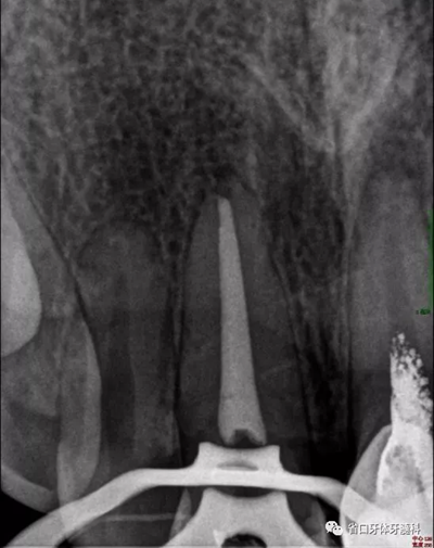 上前牙根管再治療后內(nèi)漂白1例 上前牙根管再治療后內(nèi)漂白1例