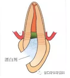 上前牙根管再治療后內(nèi)漂白1例 上前牙根管再治療后內(nèi)漂白1例