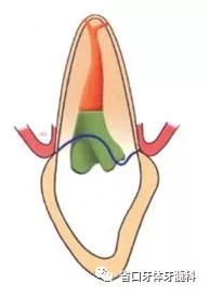 上前牙根管再治療后內(nèi)漂白1例 上前牙根管再治療后內(nèi)漂白1例