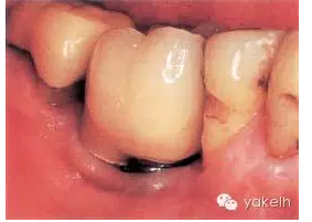 種植失敗的原因 種植失敗的原因