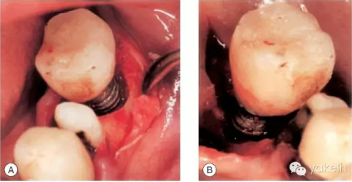 種植失敗的原因 種植失敗的原因