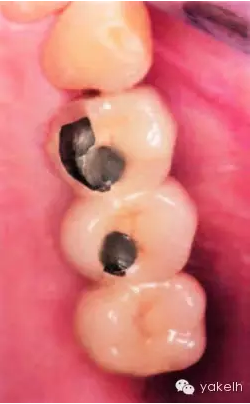 種植失敗的原因 種植失敗的原因