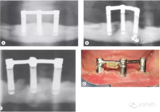 種植失敗的原因 種植失敗的原因