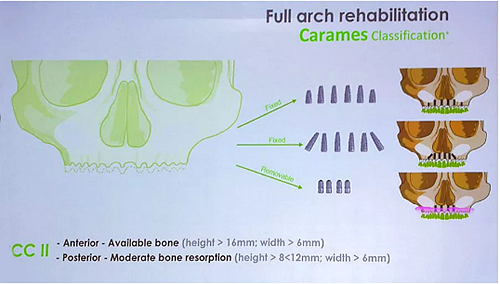 【熱點回顧】帶您深度了解無牙頜種植修復(fù)——Pro Arch 【熱點回顧】帶您深度了解無牙頜種植修復(fù)——Pro Arch