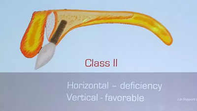 【熱點回顧】帶您深度了解無牙頜種植修復(fù)——Pro Arch 【熱點回顧】帶您深度了解無牙頜種植修復(fù)——Pro Arch