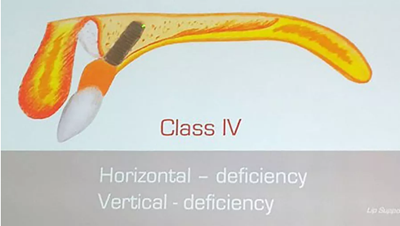 【熱點回顧】帶您深度了解無牙頜種植修復(fù)——Pro Arch 【熱點回顧】帶您深度了解無牙頜種植修復(fù)——Pro Arch