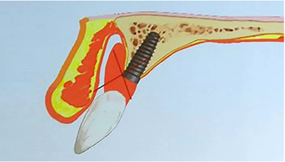 【熱點回顧】帶您深度了解無牙頜種植修復(fù)——Pro Arch 【熱點回顧】帶您深度了解無牙頜種植修復(fù)——Pro Arch