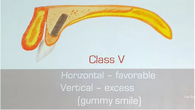 【熱點回顧】帶您深度了解無牙頜種植修復(fù)——Pro Arch 【熱點回顧】帶您深度了解無牙頜種植修復(fù)——Pro Arch