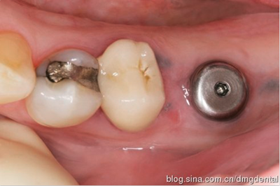 德國DMG哈尼格二代加聚硅橡膠Heavy種植印模病例展示 Part 1 德國DMG哈尼格二代加聚硅橡膠Heavy種植印模病例展示 Part 1