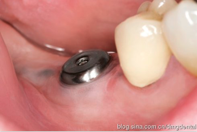 德國DMG哈尼格二代加聚硅橡膠Heavy種植印模病例展示 Part 1 德國DMG哈尼格二代加聚硅橡膠Heavy種植印模病例展示 Part 1