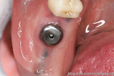 德國DMG哈尼格二代加聚硅橡膠Heavy種植印模病例展示 Part 1 德國DMG哈尼格二代加聚硅橡膠Heavy種植印模病例展示 Part 1
