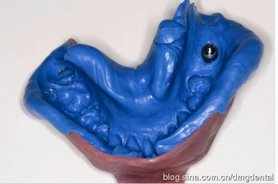 德國DMG哈尼格二代加聚硅橡膠Heavy種植印模病例展示 Part 1 德國DMG哈尼格二代加聚硅橡膠Heavy種植印模病例展示 Part 1