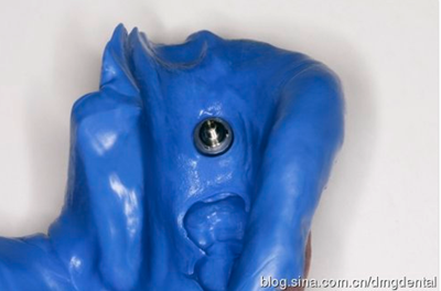 德國DMG哈尼格二代加聚硅橡膠Heavy種植印模病例展示 Part 1 德國DMG哈尼格二代加聚硅橡膠Heavy種植印模病例展示 Part 1