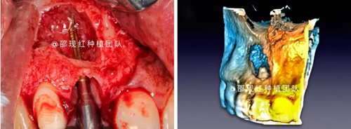 「科普篇」你真的了解它嗎？&mdash;&mdash;β-磷酸三鈣