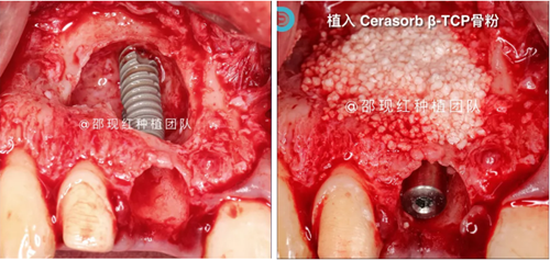 「科普篇」你真的了解它嗎？&mdash;&mdash;β-磷酸三鈣