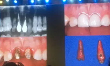 【聽課筆記】拔牙后位點的軟硬組織處理 【聽課筆記】拔牙后位點的軟硬組織處理