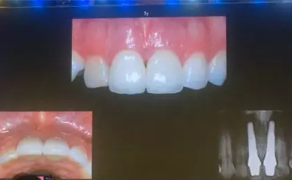 【聽課筆記】拔牙后位點的軟硬組織處理 【聽課筆記】拔牙后位點的軟硬組織處理