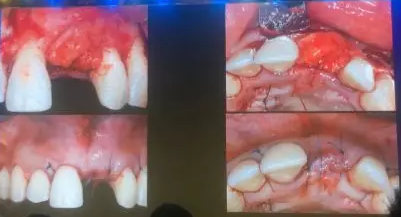 【聽課筆記】拔牙后位點的軟硬組織處理 【聽課筆記】拔牙后位點的軟硬組織處理