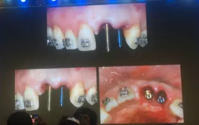 【聽課筆記】拔牙后位點的軟硬組織處理 【聽課筆記】拔牙后位點的軟硬組織處理