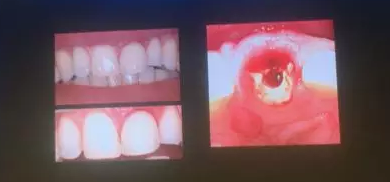 【聽課筆記】拔牙后位點的軟硬組織處理 【聽課筆記】拔牙后位點的軟硬組織處理