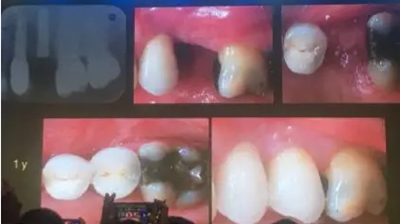 【聽課筆記】拔牙后位點的軟硬組織處理 【聽課筆記】拔牙后位點的軟硬組織處理