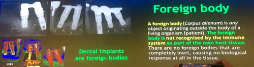 【聽課筆記】種植體周圍骨吸收因素研究與臨床意義 【聽課筆記】種植體周圍骨吸收因素研究與臨床意義