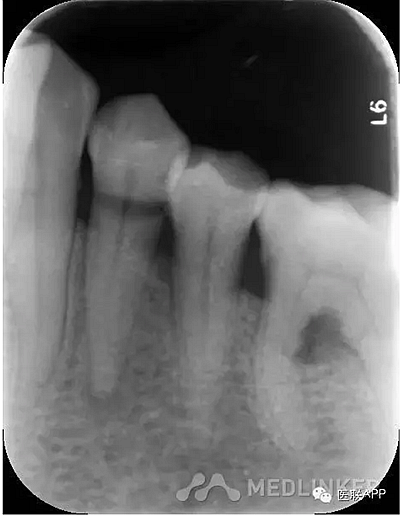 楔狀缺損導(dǎo)致根尖周炎 楔狀缺損導(dǎo)致根尖周炎