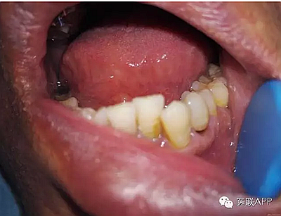 楔狀缺損導(dǎo)致根尖周炎 楔狀缺損導(dǎo)致根尖周炎