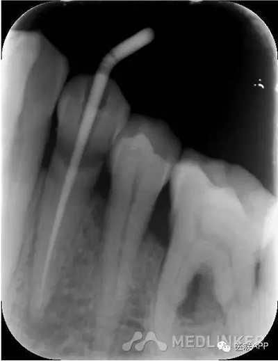 楔狀缺損導(dǎo)致根尖周炎 楔狀缺損導(dǎo)致根尖周炎