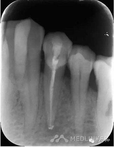 楔狀缺損導(dǎo)致根尖周炎 楔狀缺損導(dǎo)致根尖周炎