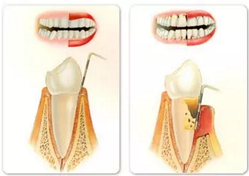 上海嘉?？谇谎芯克皇兰o(jì)牙周病的臨床進(jìn)展