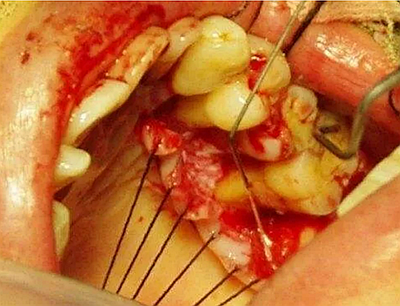 上海嘉?？谇谎芯克皇兰o(jì)牙周病的臨床進(jìn)展